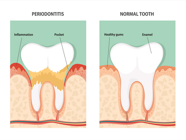Diagram of periodontitis and a healthy tooth from Watermark Dentistry in Normandy Park, WA