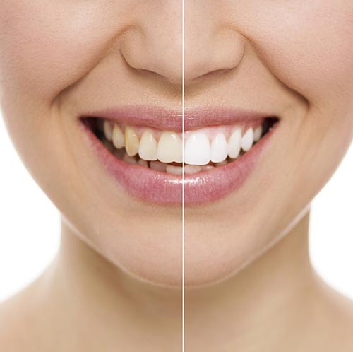 Before and after teeth whitening treatment at Watermark Dentistry in Normandy Park, WA